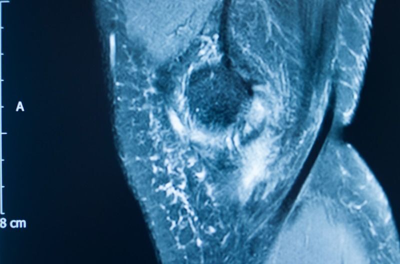 OSSIO's bio-integrative suture anchors can be used in a wide variety of procedures: ©EdwardOlive - stock.adobe.com